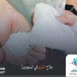 علاج الشبو في السعودية
